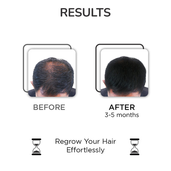 HAIR GROWTH SERUM - WITH THE MODERN HAIR GROWTH BOOSTER